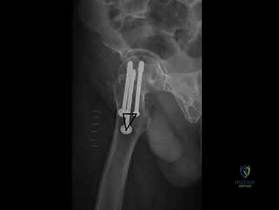 صورة طبية: دليل شامل لكسور وإصابات الجهاز الحركي: رعاية متقدمة في صنعاء مع الأستاذ الدكتور محمد هطيف