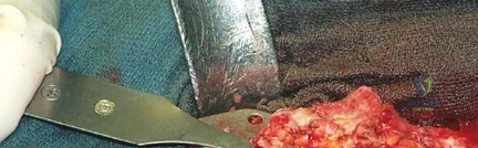 صورة طبية: جراحة استبدال مفصل الورك الملتهب في مرحلة واحدة: حل فعال وشامل مع الأستاذ الدكتور محمد هطيف