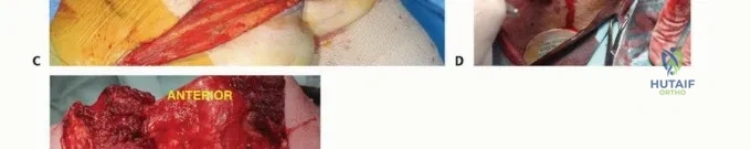 استخدام المفاصل الصناعية في إنقاذ الأطراف