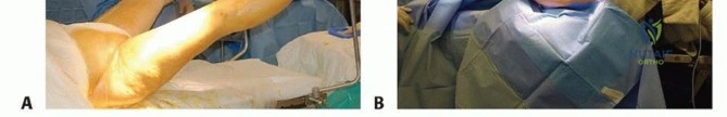 صورةCT Scan لمفصل الورك