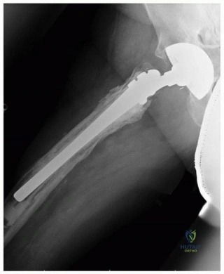صورة طبية: إتقان مراجعة استبدال مفصل الورك: استراتيجيات تحديات الأنسجة المحلية الضارة