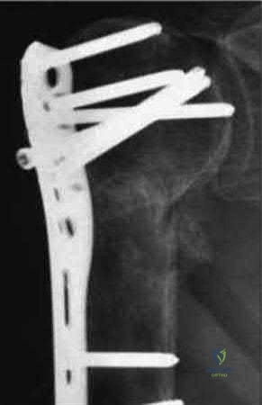 صورة طبية: دليل شامل لكسور وإصابات الجهاز الحركي: رعاية متقدمة في صنعاء مع الأستاذ الدكتور محمد هطيف