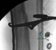 صورة طبية: كسر قصبة الساق الممتد إلى مفصل الكاحل (البلافون): أسرار العلاج بالمسمار النخاعي مع الأستاذ الدكتور محمد هطيف