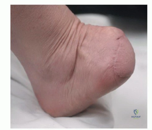 Illustration of tumors of the foot - Dr. Mohammed Hutaif