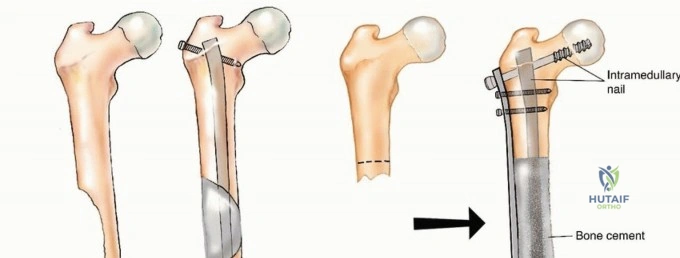 صورة طبية: مرض العظام النقيلي: دليل شامل للمرضى حول التخطيط الجراحي والعلاج لمنع الفشل مع الأستاذ الدكتور محمد هطيف في صنعاء