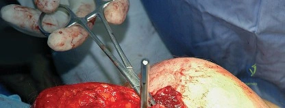 صورة توضيحية لـ النهج الخلفي لمفصل الورك: دليل شامل لاستعادة الحركة في صنعاء مع الأستاذ الدكتور محمد هطيف