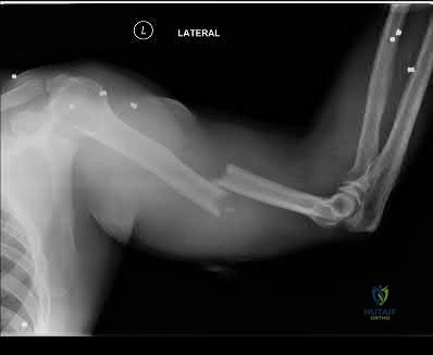 صورة طبية: دليل شامل لكسور وإصابات الجهاز الحركي: رعاية متقدمة في صنعاء مع الأستاذ الدكتور محمد هطيف