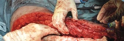 صورة طبية: جراحة استبدال مفصل الورك الملتهب في مرحلة واحدة: حل فعال وشامل مع الأستاذ الدكتور محمد هطيف