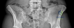 Conservative Hip Surgery: Relief for Bilateral Dysplasia