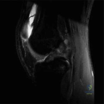 ABOS Orthopedic Spine MCQs (Set 2): Degenerative Lumbar & Cervical Trauma | 2026 Board Review