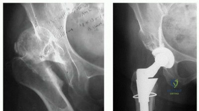صورة طبية: التغلب على تشوهات الفخذ القريب في جراحة استبدال مفصل الورك الكلي: استراتيجيات متقدمة مع الأستاذ الدكتور محمد هطيف