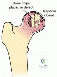 Illustration 10 for Head-Sparing for Osteonecrosis of the Femoral: Preserve Your Hip