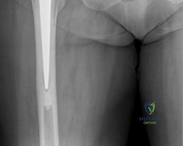 صورة توضيحية لـ جراحة استبدال مفصل الورك الهجين لكسور عنق الفخذ المتبدلة دليل شامل للمرضى مع الأستاذ الدكتور محمد هطيف