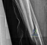 صورة توضيحية لـ كسر قصبة الساق الممتد إلى مفصل الكاحل (البلافون): أسرار العلاج بالمسمار النخاعي مع الأستاذ الدكتور محمد هطيف