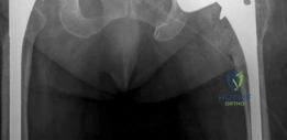 Illustration of highly porous metal - Dr. Mohammed Hutaif