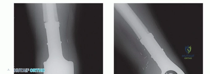 صورة طبية: النقائل العظمية الفخذية: دليل شامل للعلاج واستعادة الوظيفة مع الأستاذ الدكتور محمد هطيف في صنعاء