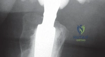 صورة توضيحية لـ استبدال مفصل الورك بجذع الفخذ الإسمنتي: دليل شامل للمرضى مع الأستاذ الدكتور محمد هطيف