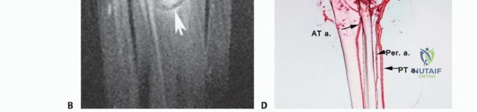 صورة توضيحية لـ استئصال ورم العضلة النعلية: دليل شامل لحماية عضلة الساق والتعافي الكامل في صنعاء مع الأستاذ الدكتور محمد هطيف