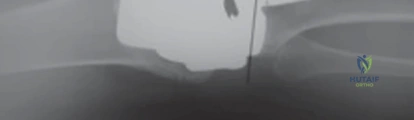 أشعة توضح التخلخل العقيم للمفصل