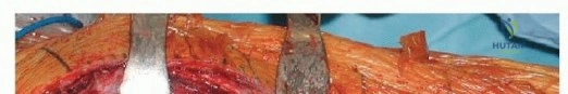 صورة توضيحية لـ إنقاذ الأطراف: أحدث التطورات في استبدال الجزء العلوي من عظم الفخذ