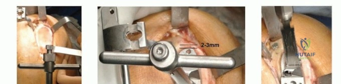 صورة توضيحية لـ استبدال مفصل الركبة الجزئي: حل متقدم لآلام الركبة المستمرة مع الأستاذ الدكتور محمد هطيف