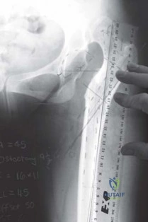 صورة طبية: استبدال مفصل الورك الكلي الناجح في خلل التنسج النمائي للورك: دليل شامل من الأستاذ الدكتور محمد هطيف