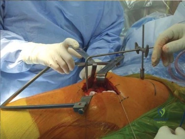 صورة طبية: استبدال مفصل الورك الكلي الناجح في خلل التنسج النمائي للورك: دليل شامل من الأستاذ الدكتور محمد هطيف