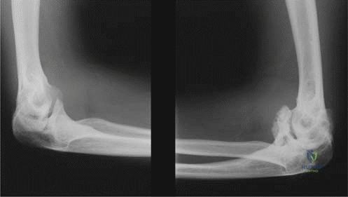 Illustration of multiple epiphyseal dysplasia - Dr. Mohammed Hutaif