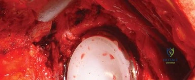 صورة طبية: المدخل الخلفي الجانبي لجراحة استبدال مفصل الورك الكلي: دليل شامل للمرضى في صنعاء مع الأستاذ الدكتور محمد هطيف