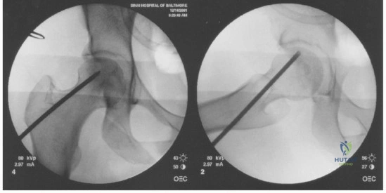 Illustration 4 for Head-Sparing for Osteonecrosis of the Femoral: Preserve Your Hip