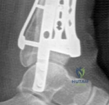 Illustration of distal radius fracture - Dr. Mohammed Hutaif