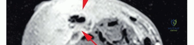 صورة توضيحية للتشريح العظمي للذراع ومستويات البتر المحتملة