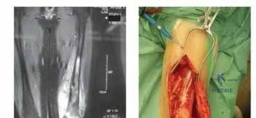 صورة توضيحية لـ الأطراف الصناعية القابلة للتمدد للأطفال: دليل شامل للمرضى حول الوقاية من العدوى والعلاج في صنعاء مع الأستاذ الدكتور محمد هطيف