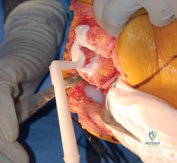 صورة طبية: إتقان موازنة الفجوة في مراجعة استبدال مفصل الركبة: تجنب الأخطاء الشائعة واستعادة الحركة مع الأستاذ الدكتور محمد هطيف