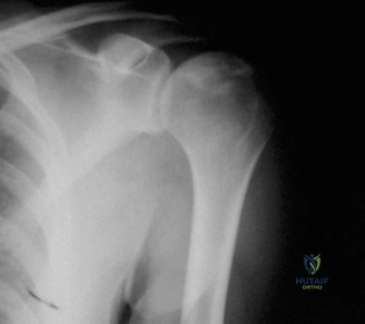استخدام أشرطة المقاومة