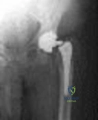 Advanced Orthopedic MCQs: ACL Cysts, Biceps Dislocation, Olecranon Fractures & Sports Injuries