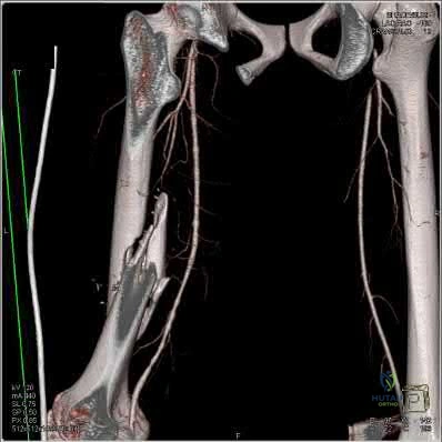 Orthopedic Trauma MCQs: Ace the Orthocash a yearold Challenge