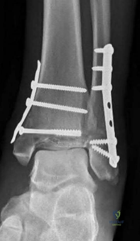 Orthopedic Trauma MCQs: What Happens When a 28-year-old Male Sustains a Fracture?