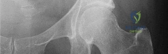 Illustration of loss of supination - Dr. Mohammed Hutaif