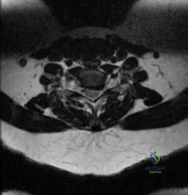 Orthopedic Spine MCQ: The Res Question a Yearold Needs to Solve