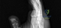Pediatric Orthopedic MCQs: The year-old boy's question explained