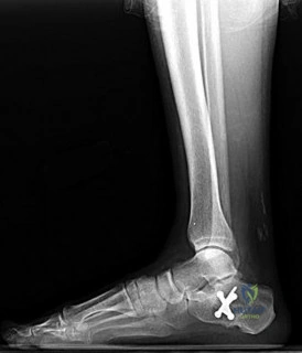 Foot & Ankle Ortho MCQs: Review, View PubMed PMID Insights