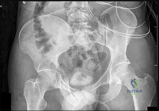 Ace wellfixed uncemented stem: Essential Orthopedic MCQs