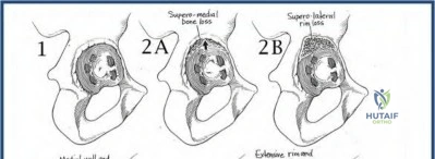 Orthopedic MCQs: Avoid Failure Following Total Hip & Knee Reconstruction