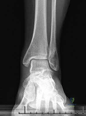 Identify the Critical Injury Shown in Figure: Orthopedic Trauma MCQ