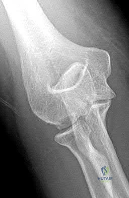 Illustration 82 for OrthoCash: Trauma MCQs & Cases for a yearold woman