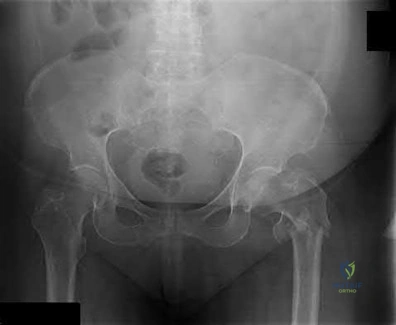 Illustration 108 for OrthoCash: Trauma MCQs & Cases for a yearold woman