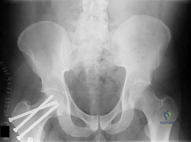 Illustration 111 for OrthoCash: Trauma MCQs & Cases for a yearold woman