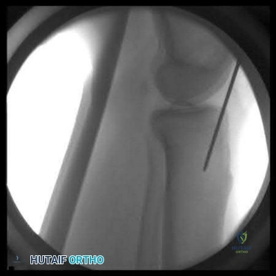 Illustration 3 for OrthoCash: Trauma MCQs & Cases for a yearold woman