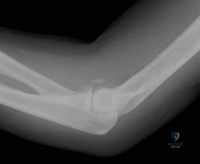 Illustration 169 for OrthoCash: Trauma MCQs & Cases for a yearold woman